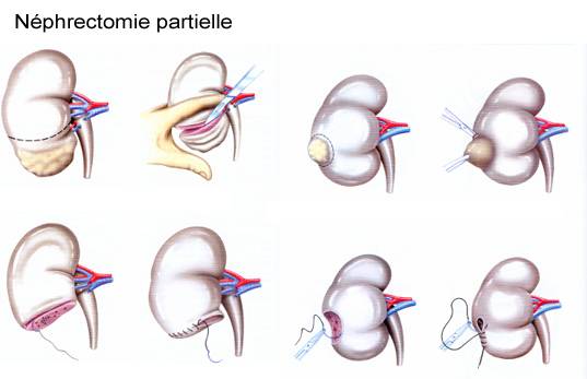 specialiste tumeur du rein